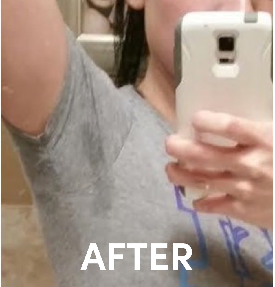 Photo showing minimal sweat after miraDry treatment