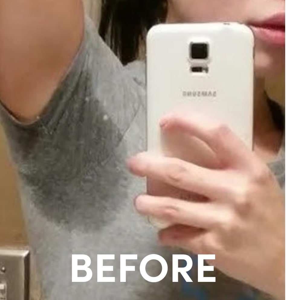 Photo showing sweat prior to miraDry treatment