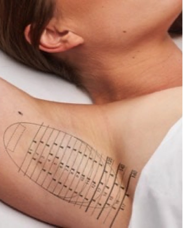 Photo of a woman's armpit with a temporary tattoo in preparation for treatment with miraDry