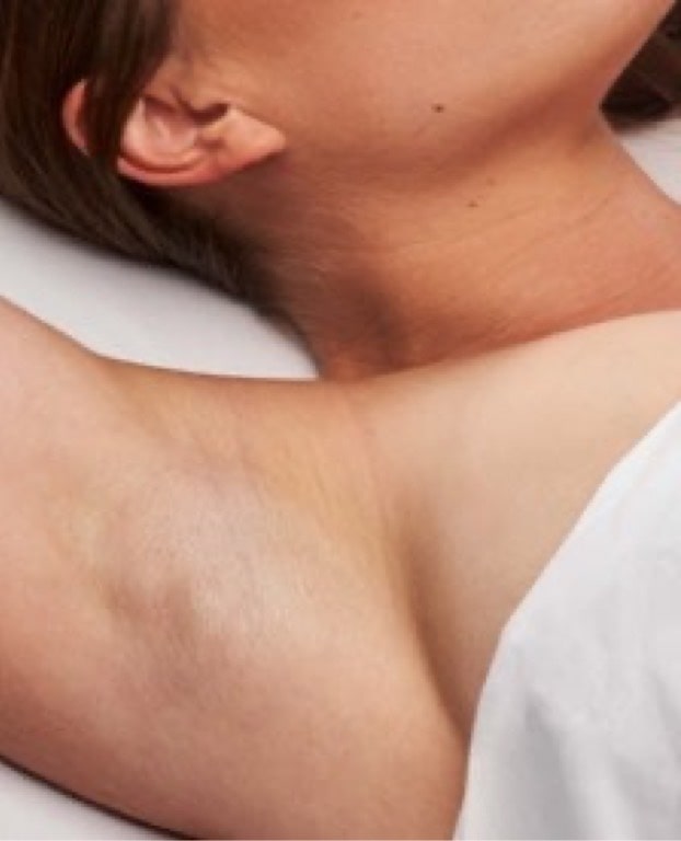 Photo of a woman's armpit prior to treatment with miraDry