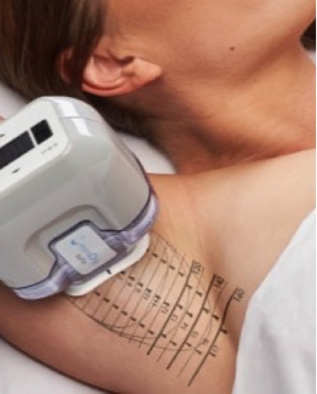 Photo of a woman's armpit during treatment with miraDry